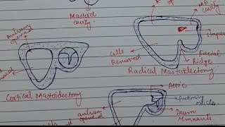 Mastoidectomy  Cortical  Radical  Modified Radical  Made Easy [upl. by Ahsatam]