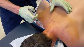 Prolotherapy amp PRP Injections for Neck Pain amp Instability [upl. by Muhcon198]