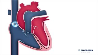 Hjärtats elektriska system  Medicinsk animation [upl. by Elinnet]