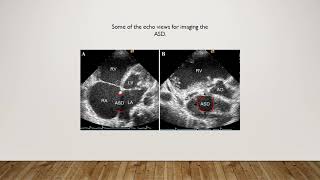 Pediatric Echo for the Adult TechnologistASDS [upl. by Anauqaj30]