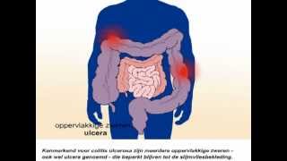 Colitis ulcerosa  Wat zijn de symptomen [upl. by Danas]