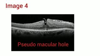 OCT MACULA Image quiz with explanation  Optometry Tamil  Made easy [upl. by Ho]