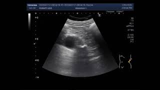 Ultrasound Video showing a large ureteral stone and Cholelithiasis [upl. by Adnylg]