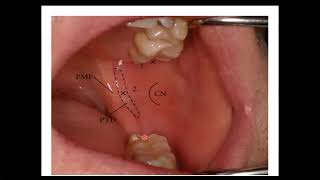 المحاضرة الثامنة  الجزء الثاني  LOCAL ANESTHESIA6 “Basic Techniques of Dental Local Anesthesia” [upl. by Enrobialc119]