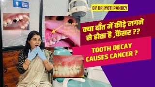 क्या दाँत में कीड़े लगने से होता है कैंसर  Is tooth decay causes CANCER [upl. by Gaye]