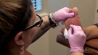 Calluses on Feet Removal Treatment and Relief [upl. by Loriner]