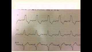 Left Bundle Branch Block [upl. by Lamrej]