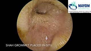 Glue Ear Otitis Media with Effusion  Treatment by Myringotomy Grommet Insertion  Dr Manish Prakash [upl. by Ester]