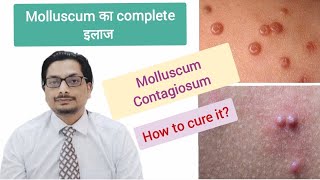 Molluscum Contagiosum Treatment  molluscum contagiosum removal  molluscum contagiosum in Hindi [upl. by Bui]