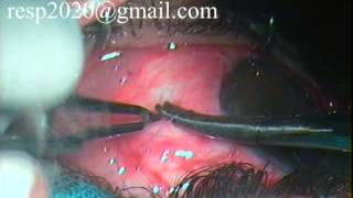 Conjunctival Graft Suturing For Pterygium Excision With Autograft By Dr Sudhir Singh 33 [upl. by Aikimat965]