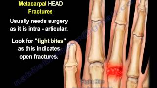 Metacarpal Fractures  Everything You Need To Know  Dr Nabil Ebraheim [upl. by Hilarius]