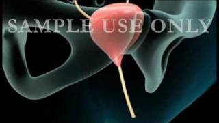 Cystoscopy  Medical Animationflv [upl. by Irmgard]