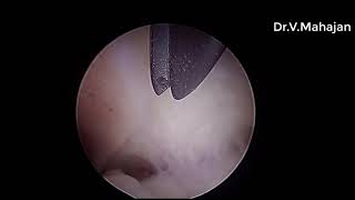 Hysteroscopic Polypectomy Septum Incision with Gubbini mini resectoscope [upl. by Ennair]