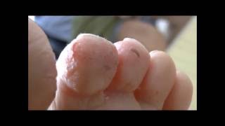 severe case of Athletes Foot before and 6 days after starting treatment [upl. by Yekcin]