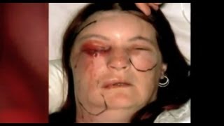 Flesh Eating Bug Ate My Eye Part 1  Bizarre ER [upl. by Elmajian]