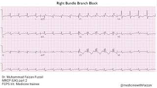 Right Bundle Branch Block RBBB pattern [upl. by Kraska684]