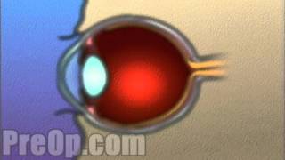 Laser Eye Lasik Surgery PreOp® Patient Engagement and Education [upl. by Vivica805]