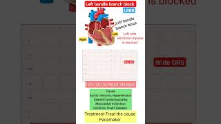 LBBB l left bundle branch block l ecg heart shorts [upl. by Rebane357]