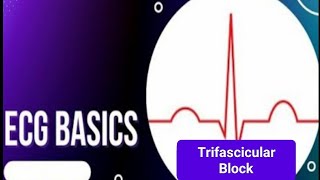 ECG Basics  Trifascicular Block ECG Criteria  causes of Trifascicular block and its significance [upl. by Lesko]