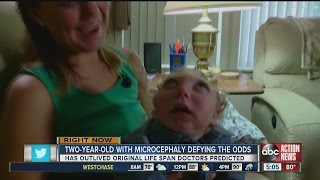 2yearold with microcephaly defying the odds [upl. by Are933]