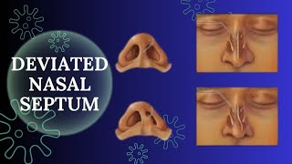 Best Treatment for Deviated Nasal Septum  ناک کی ہڈی ٹیڑھی ہونا  Dr  Tahir Aziz Zafar [upl. by Ahtram]