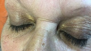 Xanthelasma dépots autour des yeux [upl. by Brady]