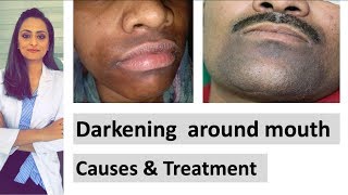 Darkening around mouth  causes  treatment  Dermatologist  Dr Aanchal Panth [upl. by Heiner]