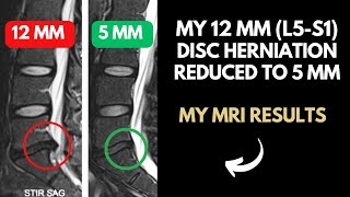 12 mm Disc Herniation Reduced to a 5 mm  12 Weeks of Limitless Transformation [upl. by Tare]