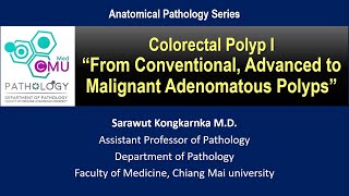 Colorectal Polyp quotFrom Conventional Advanced to Malignant Adenomatous Polypsquot [upl. by Acinad]