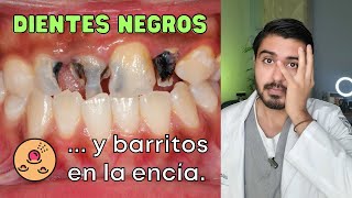 😮Coloración de los dientes  CASO REAL de un diente negro  Caries Dental [upl. by Akiemahs]