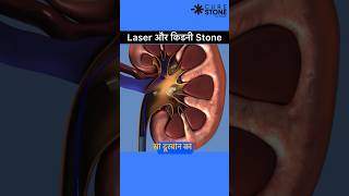 Laser और Kidney Stone  RIRS  Kidney Stone Treatment  laser Kidney stone  Curestone shorts [upl. by Ateikan]