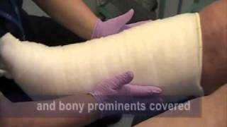 Correct way to apply toe and multilayer bandaging to Lymphoedema patients [upl. by Lengel752]