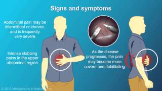 Chronic Pancreatitis [upl. by Drwde]