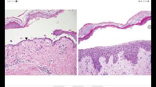 HISTOLOGÍA  PÉNFIGO FOLIÁCEO VS PENFIGOIDE AMPOLLOSO O VULGAR  EXPLICACIÓN FÁCIL [upl. by Nhaj]