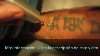 Borrar Tatuajes con laser en Lima Peru [upl. by Marita]