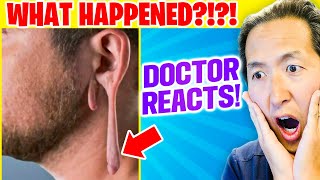 Plastic Surgeon Reacts to TORN Gauge Earlobe [upl. by Mossman591]