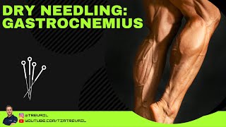 Dry Needling Gastrocnemius [upl. by Calondra]