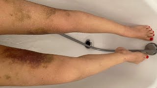 Mes jambes 10 jours après lopération du lipoedème VLOG 12 [upl. by Lotz]