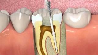 ProPoint How to obturate a root canal with SmartSeal [upl. by Grishilde257]