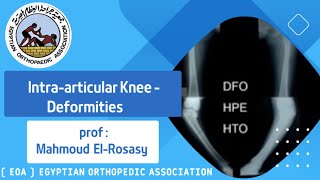 Intraarticular Knee  Deformities prof Mahmoud ElRosasy [upl. by Adianez]