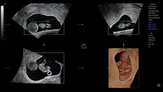 Prenatal diagnosis of a chorionic bump [upl. by Treve]