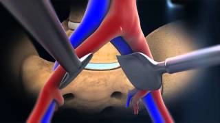 ALIF Anterior Lumbar Interbody Fusion  Larry Parker MD [upl. by Nire]