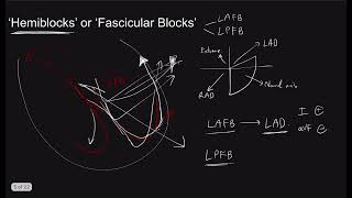 Bundle Branch Block the Series Part 2 AdvancedHemiBifascicular blocks I The Pacemaker [upl. by Eceinej]