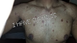 I HAVE AN STD THEY GAVE ME SYPHILIS StoryTime [upl. by Avigdor]