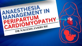 Anaesthesia Management In Peripartum Cardiomyopathy I Dr Nagesh Jambure [upl. by Quackenbush]