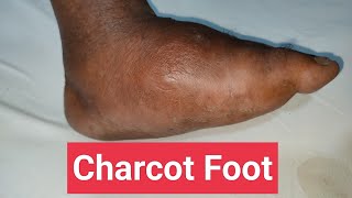 Understanding Charcot Foot in Diabetes Symptoms Treatment and Care [upl. by Hillary]