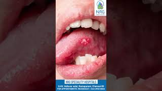 Home treatment for mouth ulcers [upl. by Axel4]