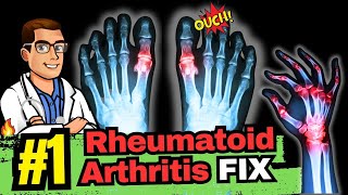 The Best Natural Treatment for Rheumatoid Arthritis [upl. by Ane]