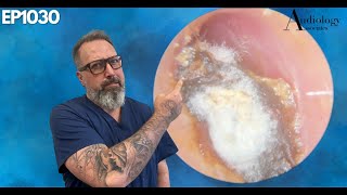 Deep Dry amp Difficult Furry Ear Wax Plug Removal  EP1030 [upl. by Fatma]