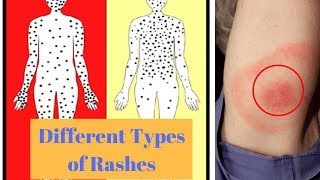 Different Types of Rashes [upl. by Ramsay754]